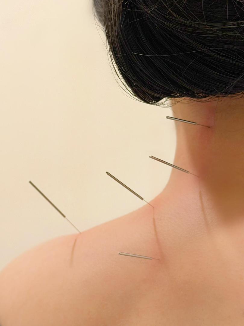 针灸 Acupuncture